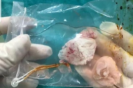 Mổ lấy ổ sán khổng lồ trong não người thích ăn tiết canh 