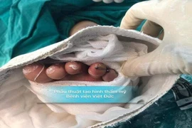 Trả lại 2 ngón chân gần như đứt hoàn toàn cho bé 6 tuổi