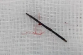 Sững sờ khi bác sĩ nói trong bụng con có cây kim dài 17 mm