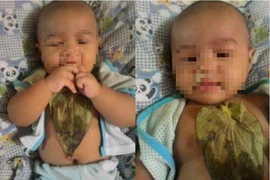 Bé gái bỏng ngực nặng vì... trị sổ mũi bằng lá trầu