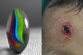 Bé trai bị đạn bị găm vào trán vì súng bắn chim cướp cò
