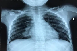 Bé trai ho ra máu, chuyển 3 BV mới phát hiện bệnh