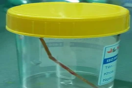 Hoãn mổ tim vì tăm tre 6 cm đâm thủng ruột 