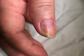 Người phụ nữ 5 năm treo tay lên đầu giường để ngủ