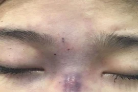 Chồng tiêm filler làm mù mắt vợ