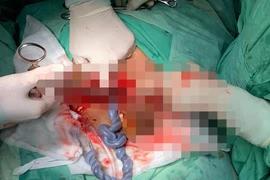 Báo động đỏ cứu bé gái thai suy vì dây rốn thắt nút
