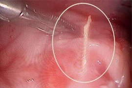 Nguyên nhân không ngờ làm bé trai thủng ruột nhiễm trùng nặng