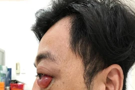 Chàng trai đột nhiên lồi mắt, suýt mù sau 2 năm bị té