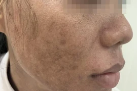 Trẻ hóa da bằng laser: Coi chừng già và xấu hơn!