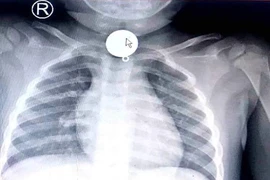 Trẻ tắc ống thực quản vì nuốt mặt dây chuyền