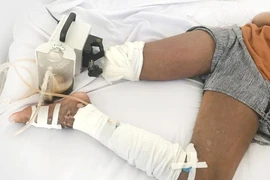Nguy cơ đoạn 2 chân vì rắn cắn 1 chân, đi hút máu độc 2 chân