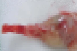 Phát hiện 1 thai nhi mắc hội chứng người cá