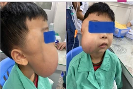 Căn bệnh khiến hàm bé trai sưng to, chảy máu mũi nhiều năm