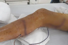 Tức tốc chạy đua cứu đôi chân người đàn ông bị máy cưa cắt