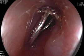 Bé gái 10 tuổi khóc nấc vì nghẹn chiếc nhẫn mới được tặng