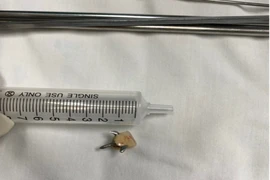 Súc miệng làm rơi răng giả, cô gái phải nhập viện cấp cứu