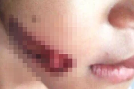 Khởi tố vụ bé 7 tuổi nghi bị gí sắt nóng vào người