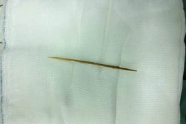 Tăm xỉa răng lọt vào bụng đâm thủng ruột non