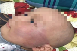 Bé trai bị tát bầm mặt: Gia đình không chấp nhận xin lỗi