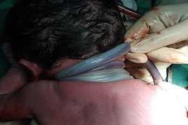 Cần Thơ: Bé trai chào đời với 4 vòng dây rốn quấn cổ