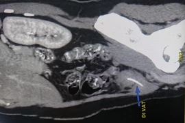 Người phụ nữ bị xương cá dài 3 cm đâm thủng ruột