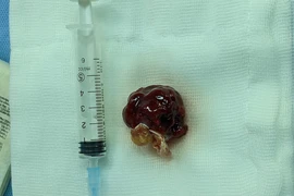 4 giờ phẫu thuật cứu người phụ nữ mang khối u trong tim