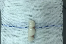 Ăn cơm, cụ bà nuốt luôn 4 răng giả mới lắp