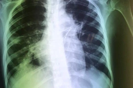 Stress do phát hiện nhiễm HIV, một phụ nữ tự đâm 7 cây kim vào ngực