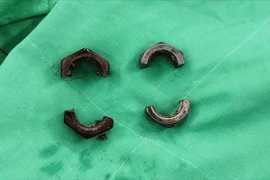 Đeo đai ốc kim loại cho 'cậu nhỏ' suốt 1 tháng, người đàn ông phải đi cấp cứu