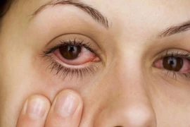 Cảnh báo việc đắp lá trầu chữa bệnh đau mắt đỏ