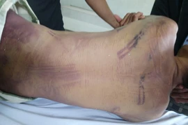 Phạm nhân chết ở nhà tạm giữ Châu Đức bị đánh bằng gậy cao su