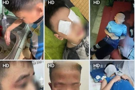 Vụ nhiều học sinh bị dị ứng: Một lớp có tới 26/47 học sinh phải nghỉ học