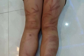 Nhóm học sinh mầm non bị đánh bầm tím, 2 em phải nhập viện
