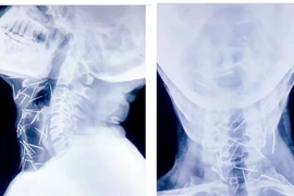 Sốc: Phát hiện 75 cây kim đâm tua tủa trong người