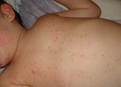Nghệ An: Ba trẻ em tử vong do sởi biến chứng