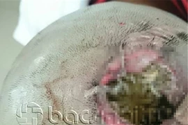 Hi hữu cứu sống bệnh nhân có giòi trong não