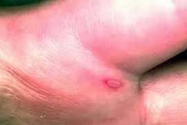 Hi hữu một người lớn mắc tay-chân-miệng