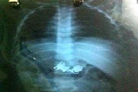 Gắp chìa khóa trong dạ dày bé trai