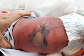 Bé sơ sinh bỏng nặng, nhiễm trùng máu do nằm than