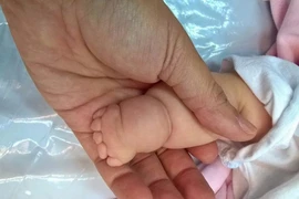 Tay chân bé có ngấn tưởng bụ bẫm, hóa ra bệnh lạ