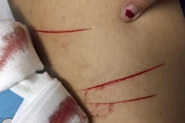 Nữ sinh bị rạch đùi phải uống phơi nhiễm HIV