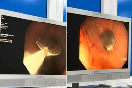 Bé trai 11 tuổi nuốt nắp lon nước ngọt vào dạ dày