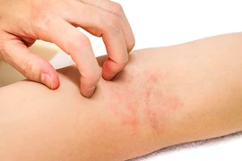 Cách chăm sóc đúng cho người bị viêm da cơ địa