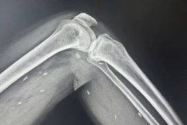 Phát hiện nhiều kén sán trong cơ thể người đàn ông thích ăn đồ sống