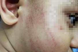Buộc thôi việc cô giáo mầm non tát trẻ bầm mặt 