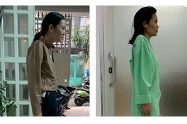 Căn bệnh khiến cô gái 30 tuổi bị còng như 60 tuổi