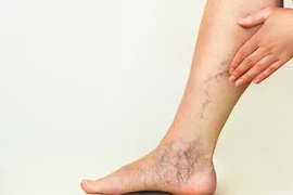 Chế độ ăn uống, tập luyện để tránh suy giãn tĩnh mạch 