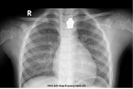 Bé gái 5 tuổi nuốt nam châm trong lúc ăn cơm