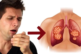 Ho mạnh có thể giúp qua cơn đột quỵ?