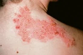 Zona thần kinh, 'ngòi nổ' cho nhiều biến chứng nguy hiểm